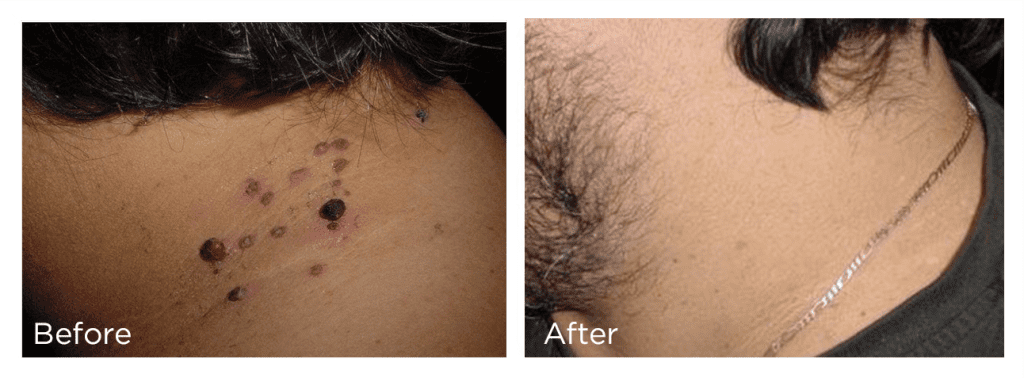 Before and After Cryotherapy / FreezPen treatment to remove skin anomalies