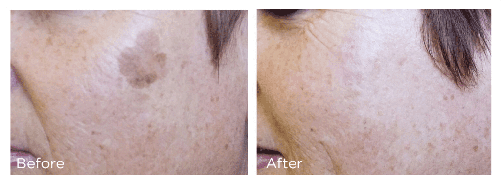 Before and after Cryotherapy Treatment of Age spot on face
