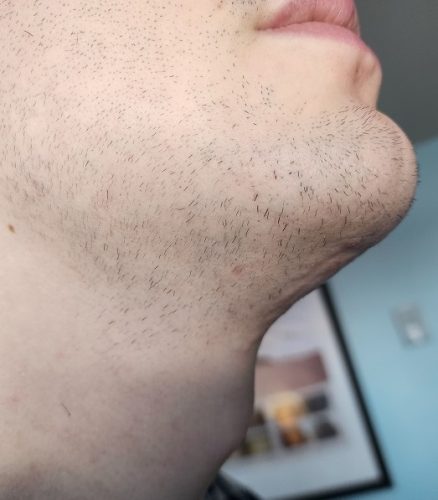 Progressive accelerated electrolysis carousel image 5